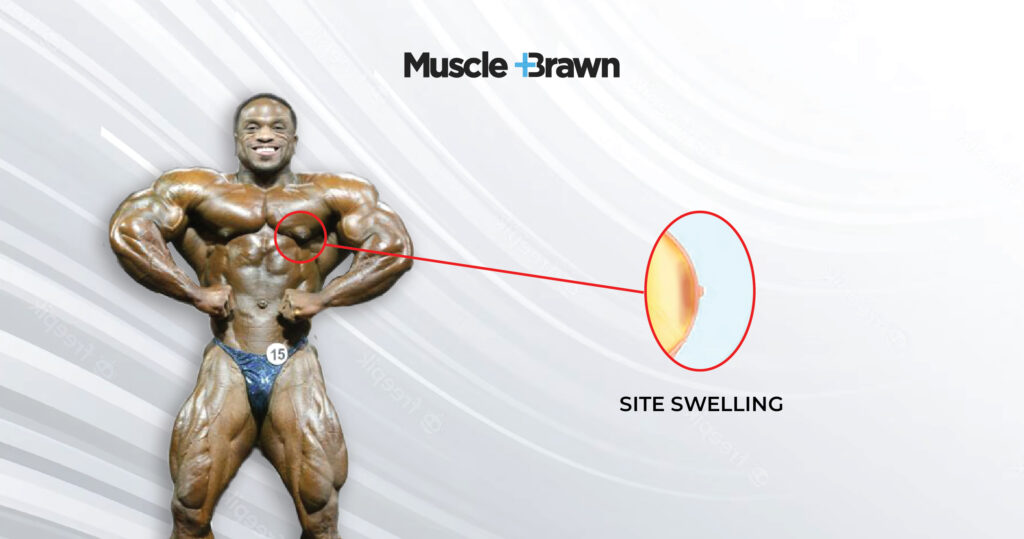 Gyno on a bodybuilder