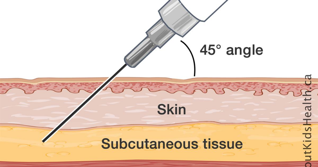 Subcutaneous Injection penetrating the skin and subcutaneous tissue at a 45 degree angle