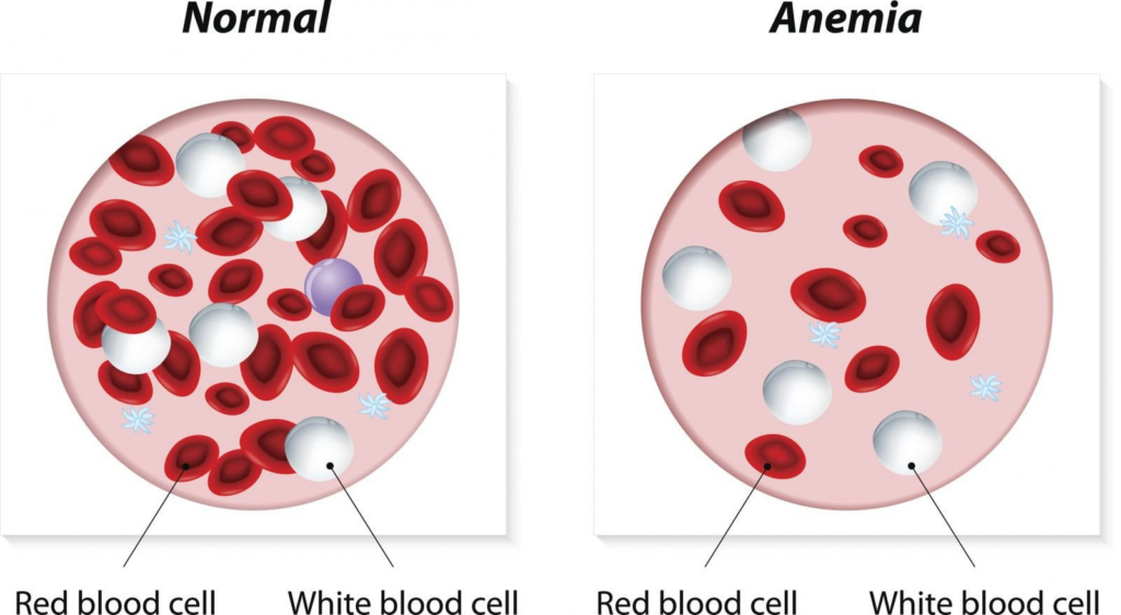 Normal vs Anemia